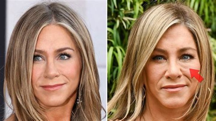 Jennifer Aniston Face Surgery