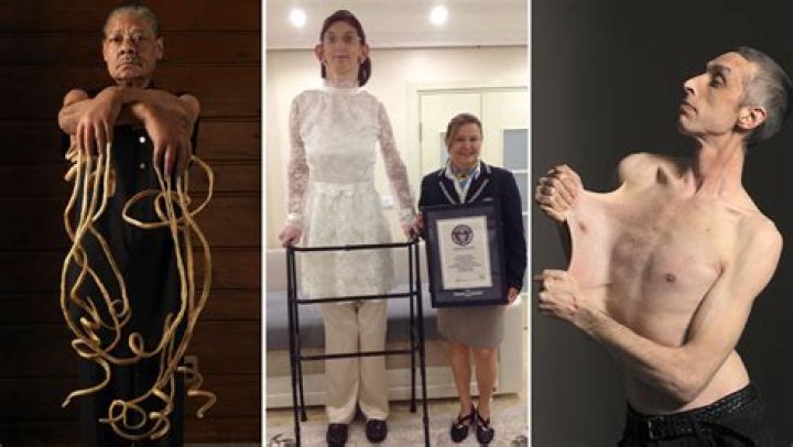 Skinniest Person In The World Facts And Stories