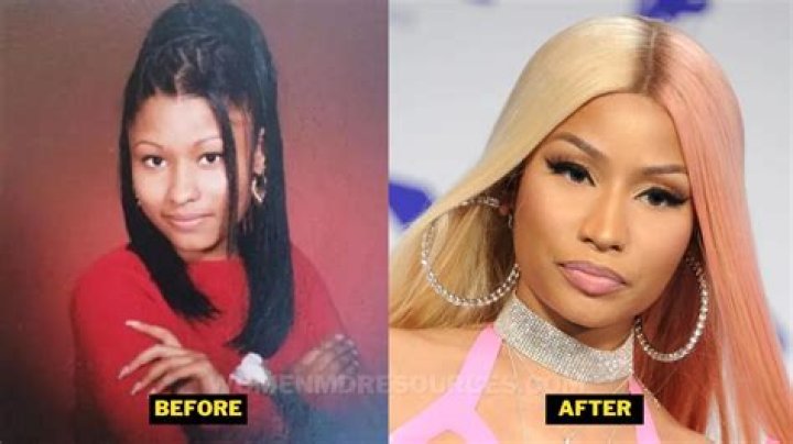 The Man Who Inspired Nicki Minaj to Get Plastic Surgery Her before Surgery and after Pictures