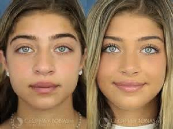 Uncovering The Secrets Behind Teresa Giudice's Nose Job