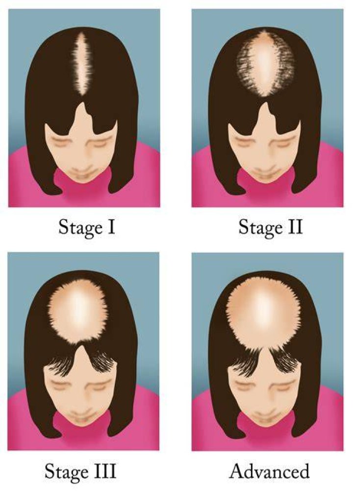 Uncovering The Truth About Hair Loss And Weight Management