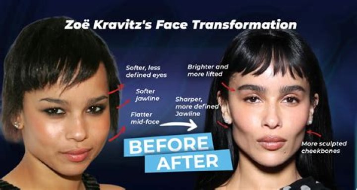 Uncovering The Truth Behind Zoe Kravitz's Plastic Surgery Journey