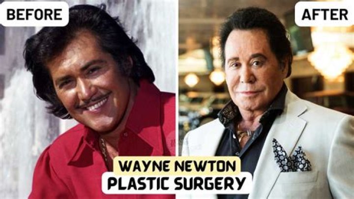 Wayne Newton Plastic Surgery, Know everything about Wayne Newton.